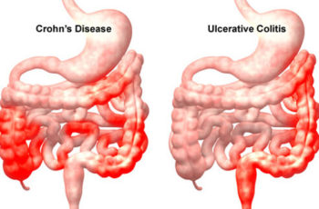 Colite Ulcerativa e Doença de Crohn